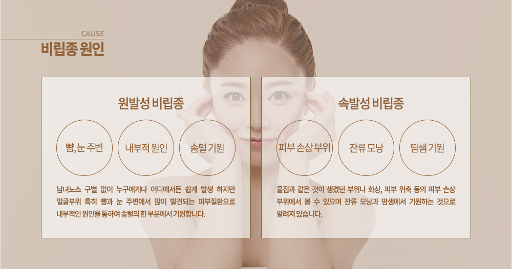 비립종 원인 ▶ 원발성 비립종
남녀노소 구별 없이 누구에게나 어디에서든 쉽게 발생 하지만 얼굴부위 특히 뺨과 눈 주변에서 많이 발견되는 피부질환으로 내부적인 원인을 통하여 솜털의 한 부분에서 기원합니다.
▶ 속발성 비립종
물집과 같은 것이 생겼던 부위나 화상, 피부 위축 등의 피부 손상 부위에서 볼 수 있으며 잔류 모낭과 땀샘에서 기원하는 것으로 알려져 있습니다.
