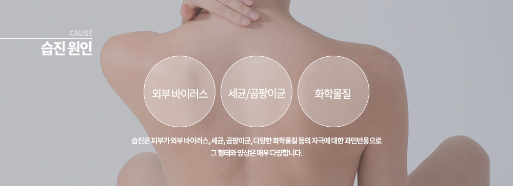 ♧ 습진 원인	
습진은 피부가 외부 바이러스, 세균, 곰팡이균, 다양한 화학물질 등의 자극에 대한 과민반응으로 그 형태와 양상은 매우 다양합니다.
